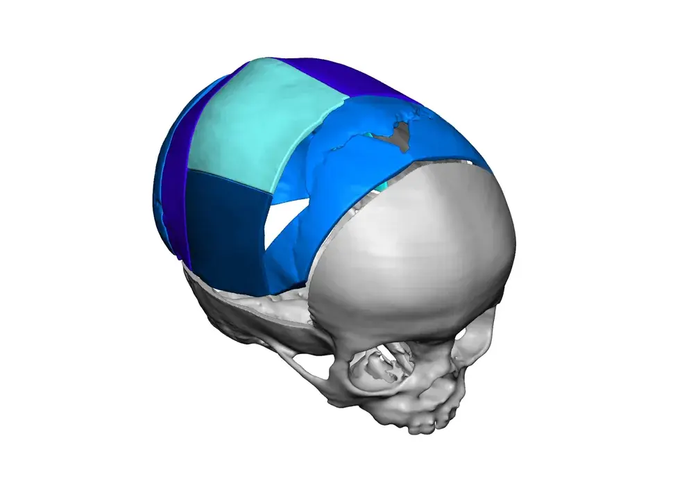 VSP Cranial Pre-Op Resected