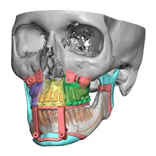 vsp orthognathics positioning iso