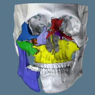 Digital Fracture Reduction