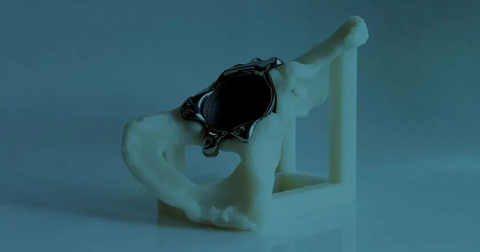 Un modello medico in metallo stampato in 3D