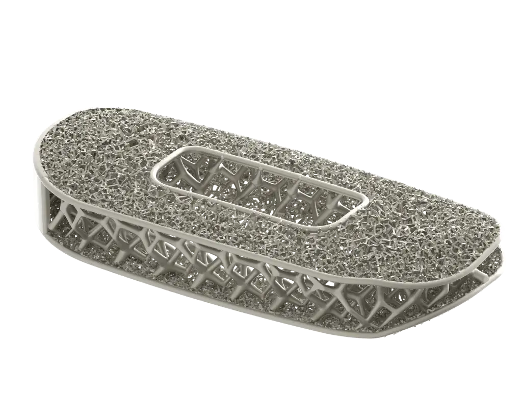Impianto spinale ottimizzato di NuVasive prodotto con la stampa 3D