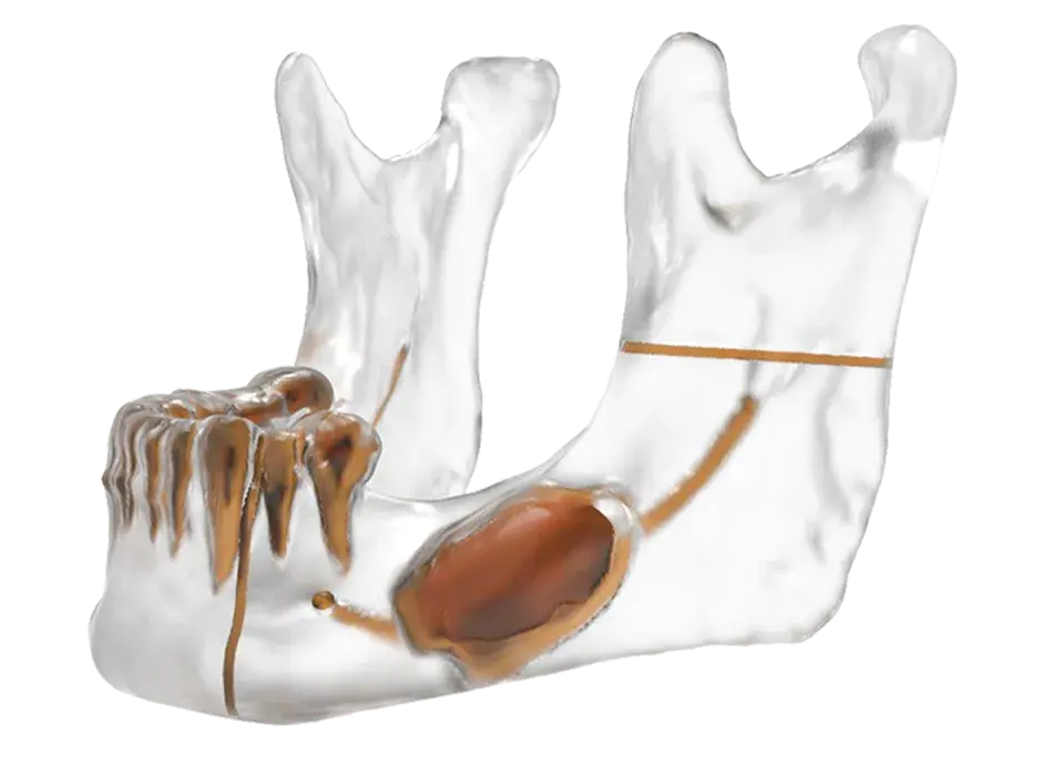 Demo of 3D print rendering of a jaw reconstruction