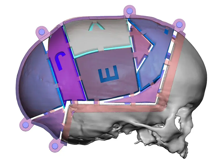 VSP Cranial Pre-Op Resected with Guides
