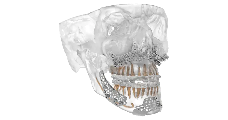 Craniomaxillofacial anatomic model with titanium osteotomy guides