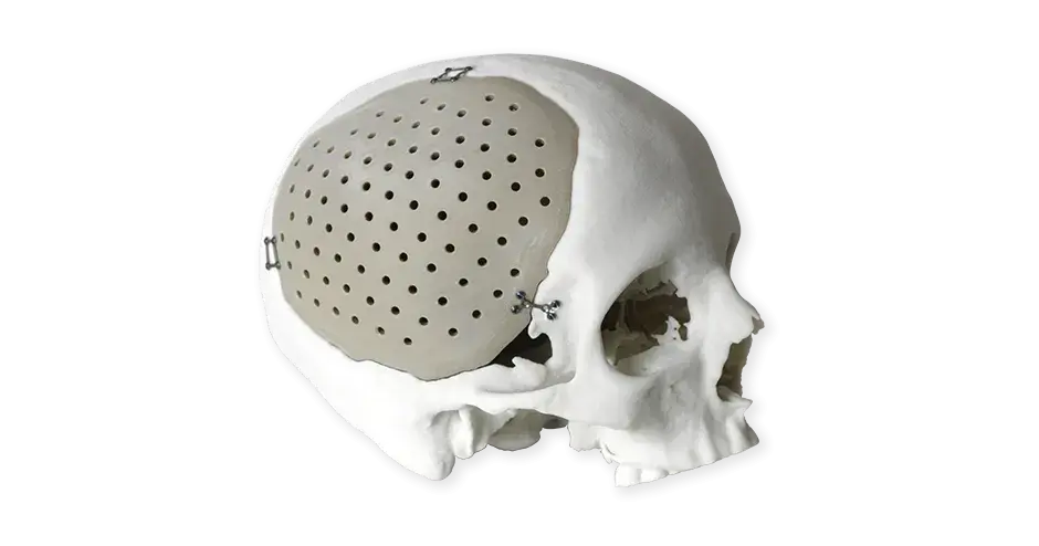 Impianti cranici PEEK
