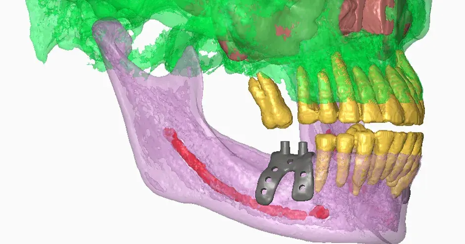 Impianti dentali di Graft3D