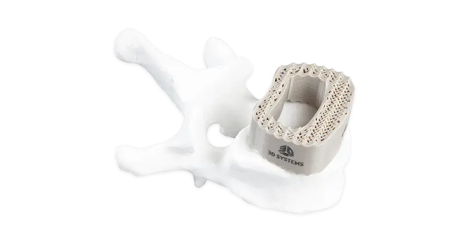Gabbia spinale in PEEK stampata in 3D