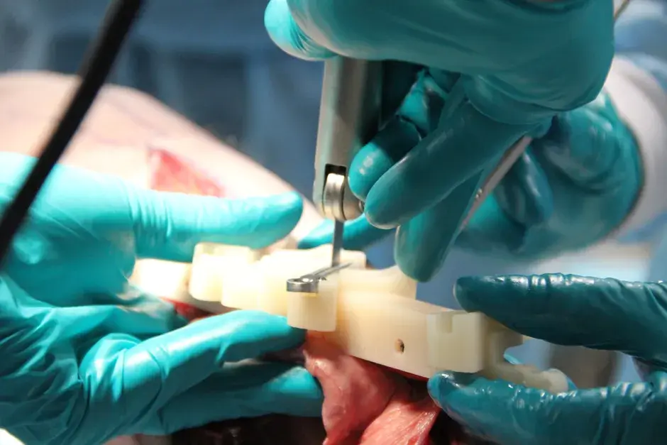 VSP Fibula guide surgery