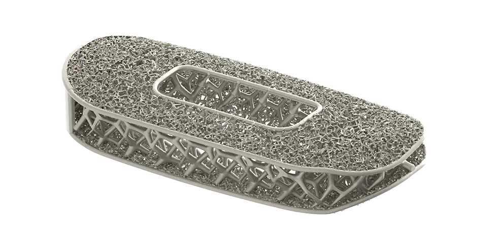 Impianto spinale ottimizzato di NuVasive prodotto con la stampa 3D 
